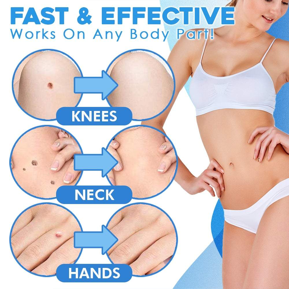 WarzenWeg™ Schmerzfreie Warzenentfernung